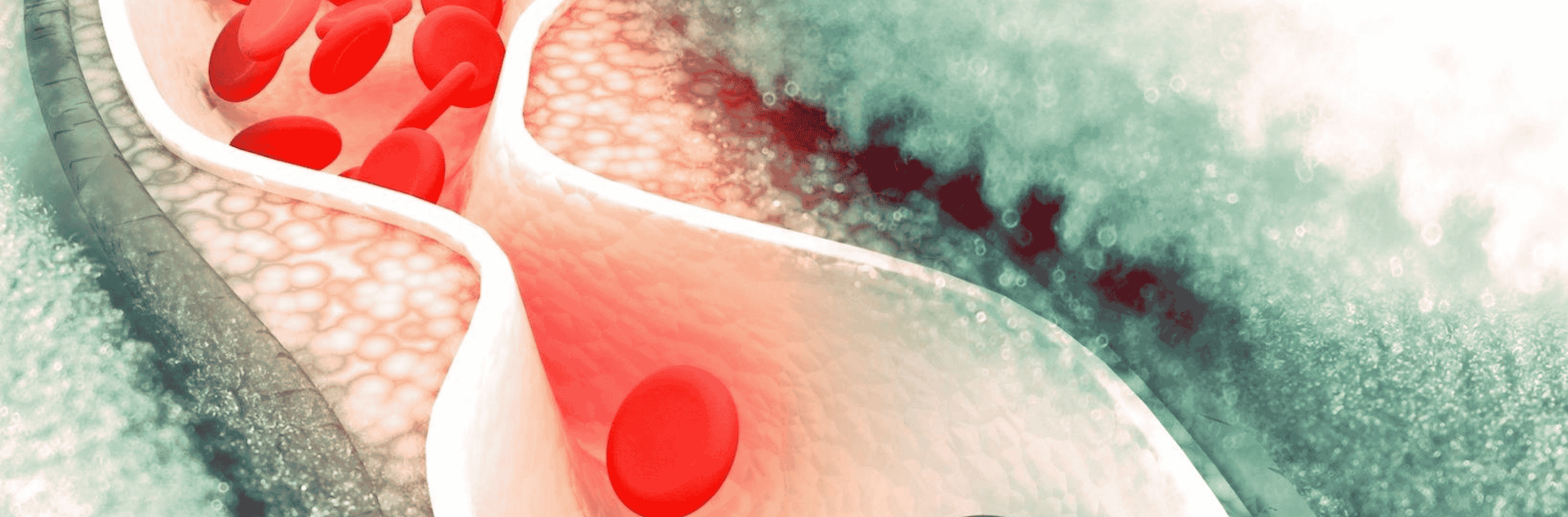 Lipoprotein(a) – the bad guy of lipids
