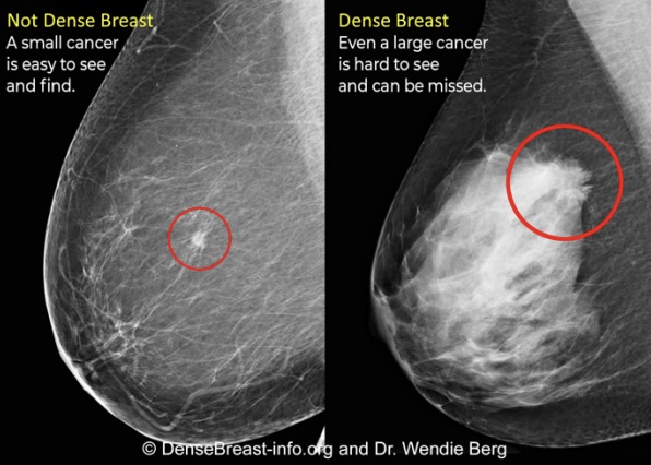 breast density mammogram