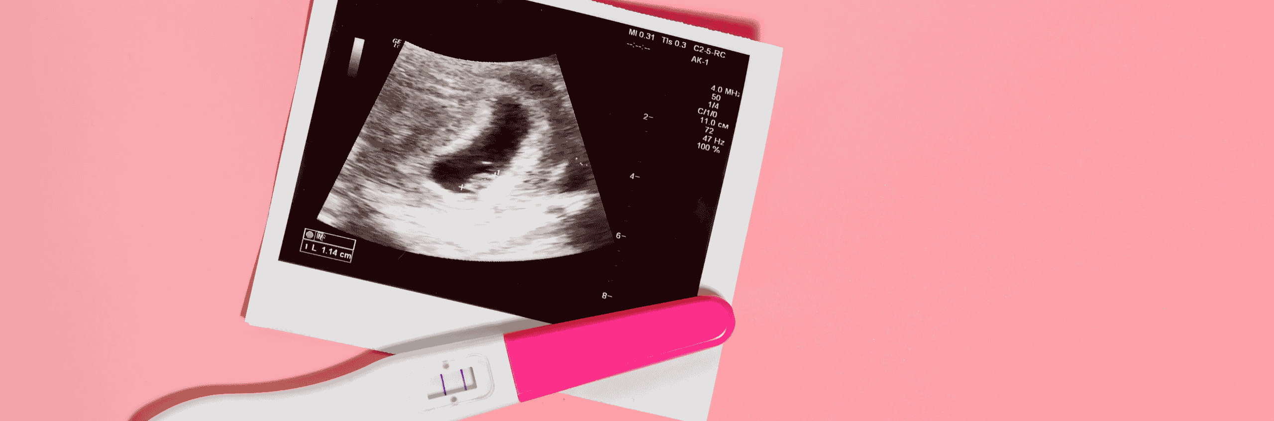 NIPT Test in London: Pregnancy Screening from 10 Weeks